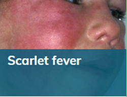 Group A Streptococcus and Scarlet Fever :: Hertfordshire and West Essex  Healthier Together